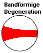 Bandfrmige Degeneration