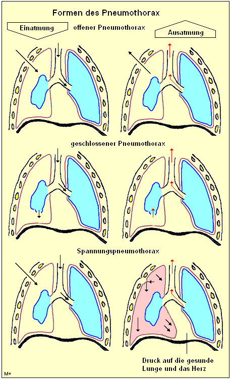 Bei Pneumothorax dringt Luft in den Pleuraspalt ein und lsst die Lunge kollabieren